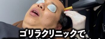 ゴリラクリニックで2回目の薄毛レーザー治療