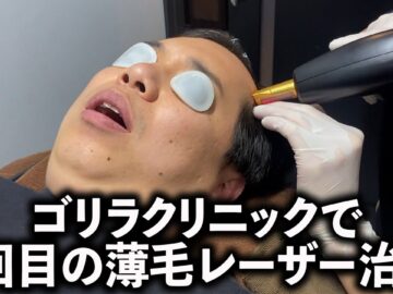 ゴリラクリニックで2回目の薄毛レーザー治療