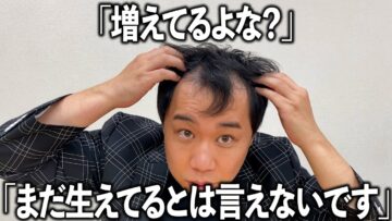 レーザー治療で増えた髪の毛をみんなに見てもらう